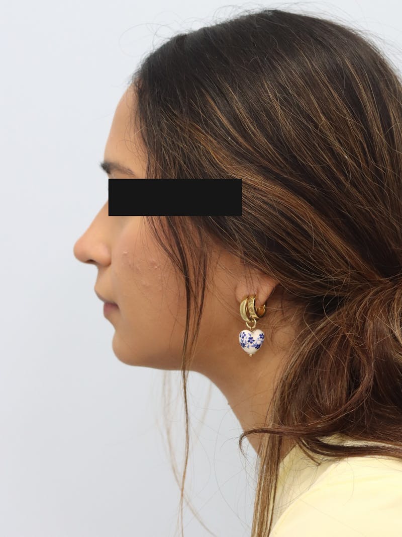 Non-Surgical Rhinoplasty Before & After Gallery - Patient 230553 - Image 6