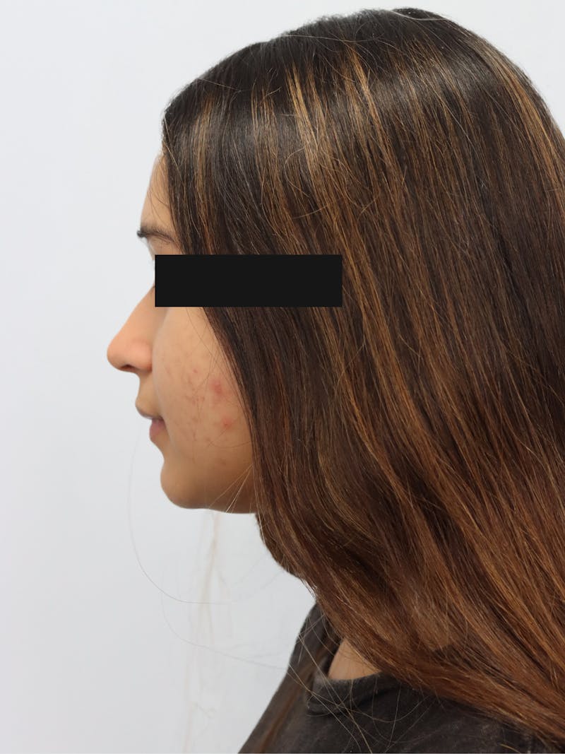 Non-Surgical Rhinoplasty Before & After Gallery - Patient 230553 - Image 5