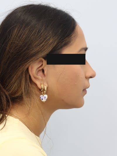 Non-Surgical Rhinoplasty Before & After Gallery - Patient 230553 - Image 2