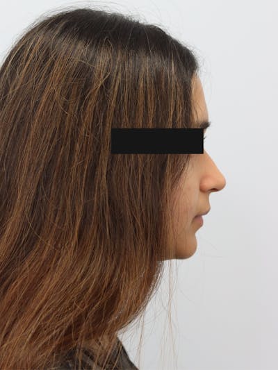 Non-Surgical Rhinoplasty Before & After Gallery - Patient 230553 - Image 1