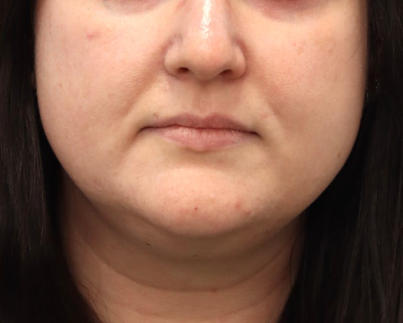 Lesion Excision Before & After Gallery - Patient 105578 - Image 2