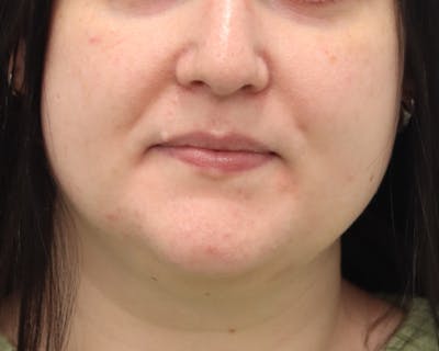 Lesion Excision Before & After Gallery - Patient 105578 - Image 1