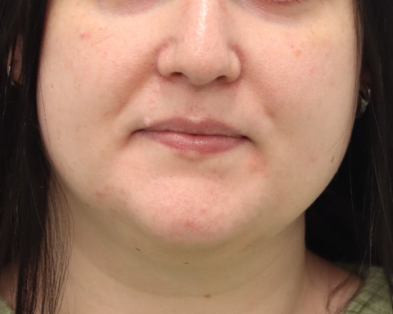 Lesion Excision Before & After Gallery - Patient 105578 - Image 1