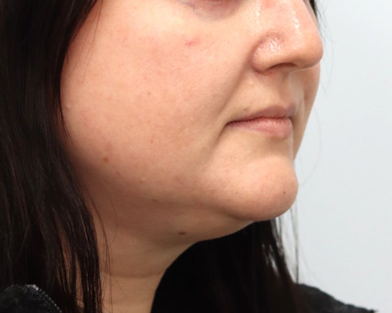 Lesion Excision Before & After Gallery - Patient 105578 - Image 4