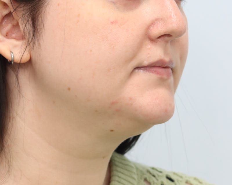 Lesion Excision Before & After Gallery - Patient 105578 - Image 3