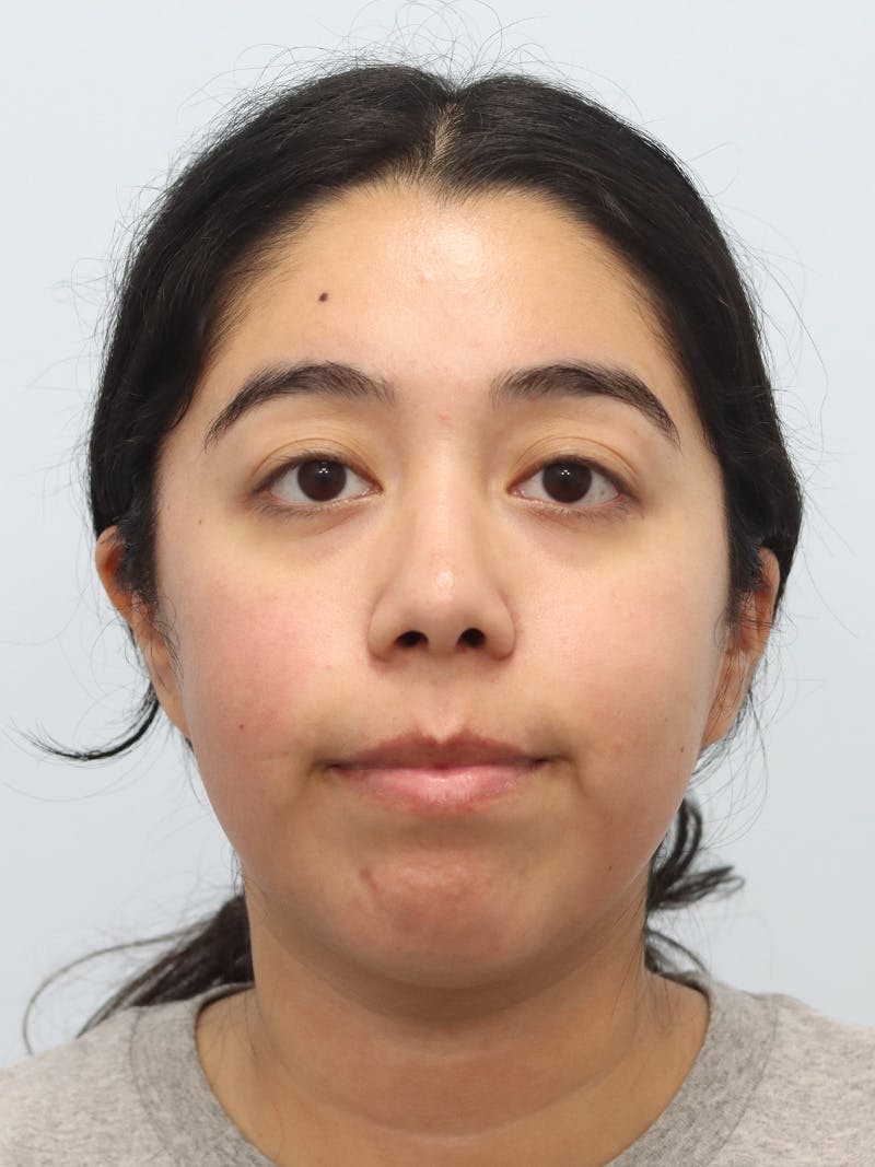 Chin Implant Before & After Gallery - Patient 183484 - Image 5