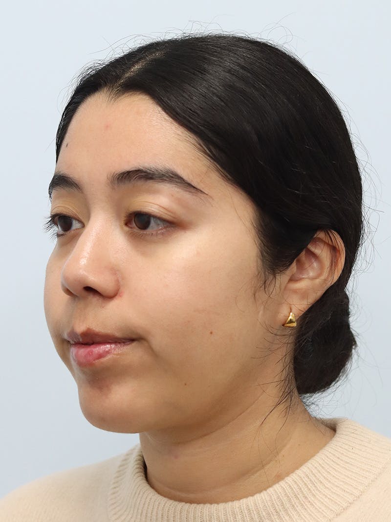 Chin Implant Before & After Gallery - Patient 183484 - Image 8