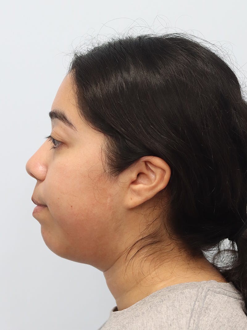 Chin Implant Before & After Gallery - Patient 183484 - Image 9