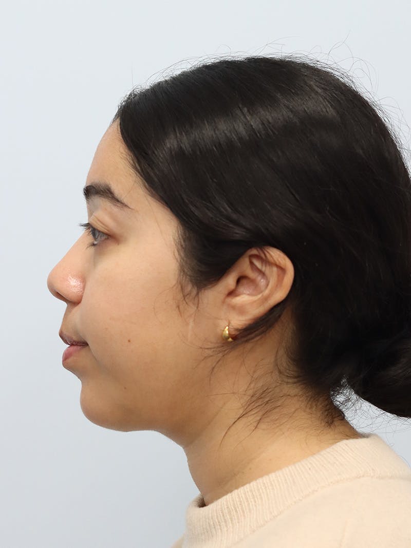 Chin Implant Before & After Gallery - Patient 183484 - Image 10