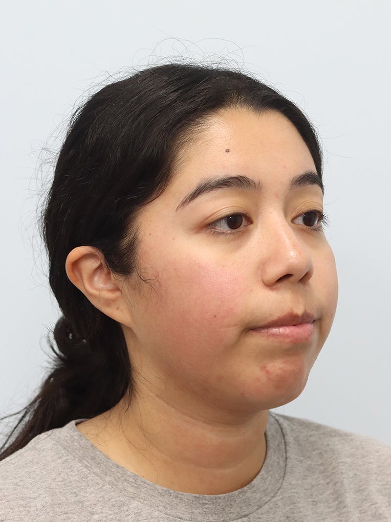Chin Implant Before & After Gallery - Patient 183484 - Image 3