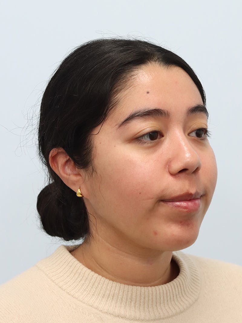 Chin Implant Before & After Gallery - Patient 183484 - Image 4