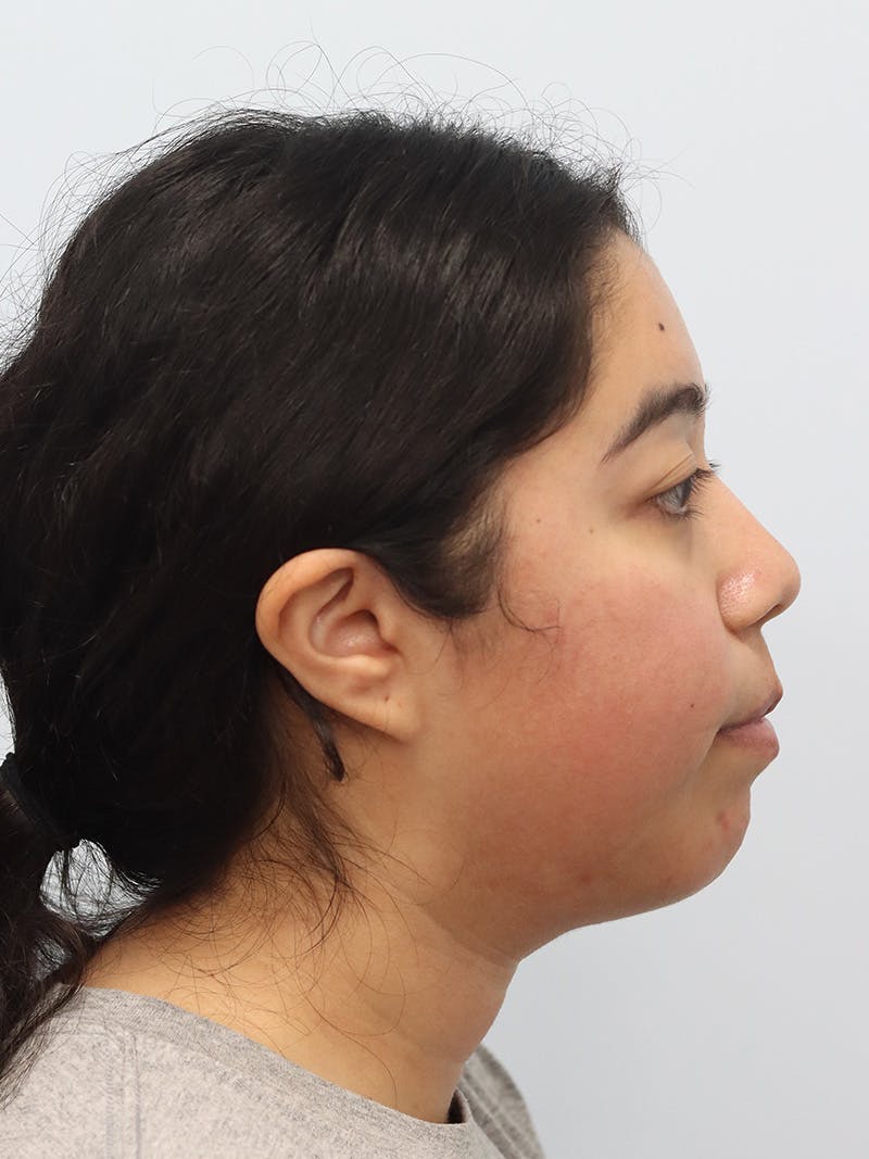 Chin Implant Before & After Gallery - Patient 183484 - Image 1