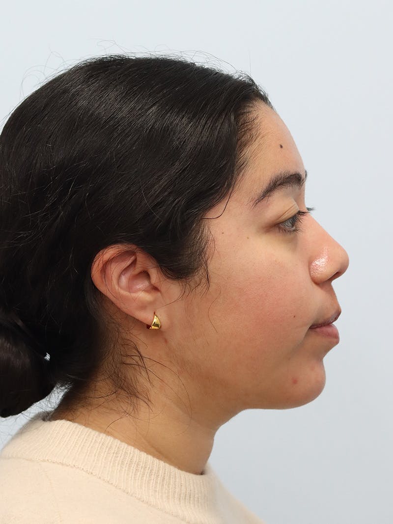Chin Implant Before & After Gallery - Patient 183484 - Image 2