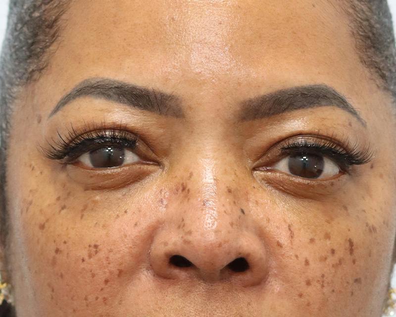Blepharoplasty Before & After Gallery - Patient 409439 - Image 2