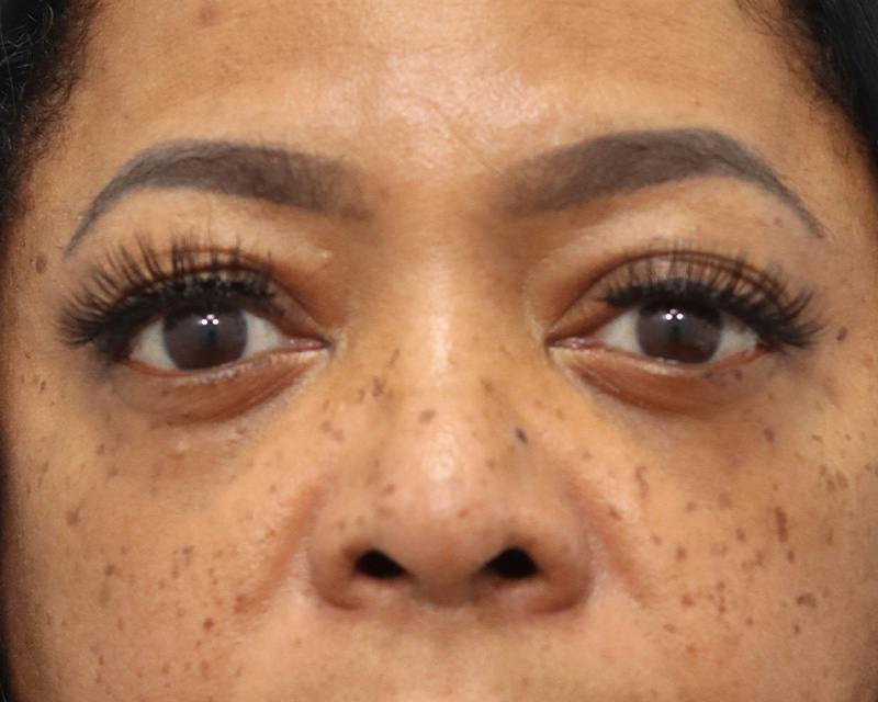 Blepharoplasty Before & After Gallery - Patient 409439 - Image 1
