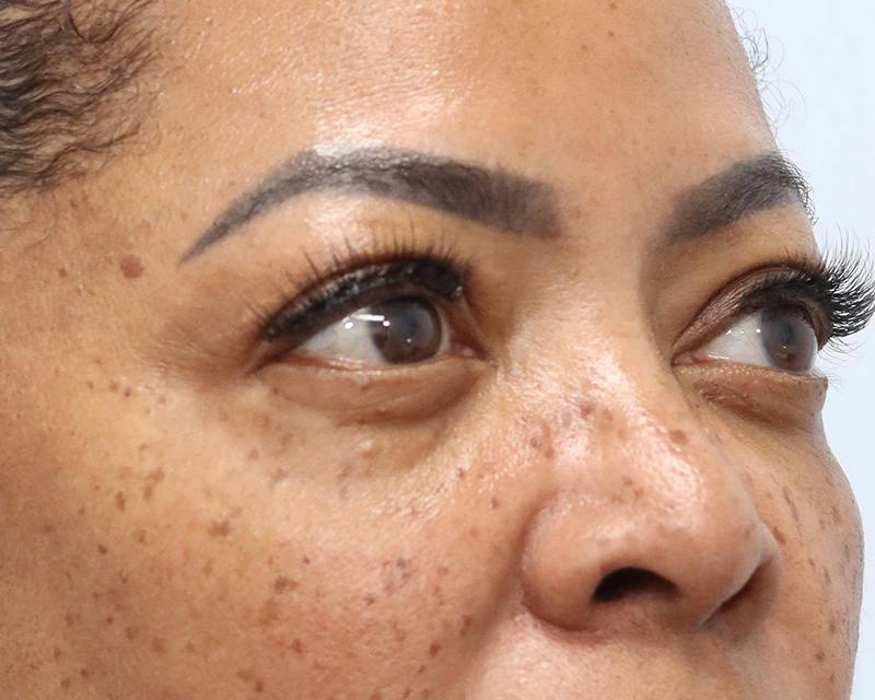 Blepharoplasty Before & After Gallery - Patient 409439 - Image 4