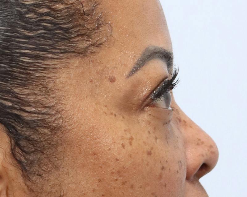 Blepharoplasty Before & After Gallery - Patient 409439 - Image 6
