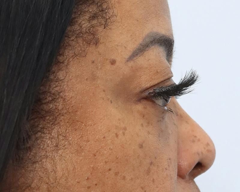 Blepharoplasty Before & After Gallery - Patient 409439 - Image 5