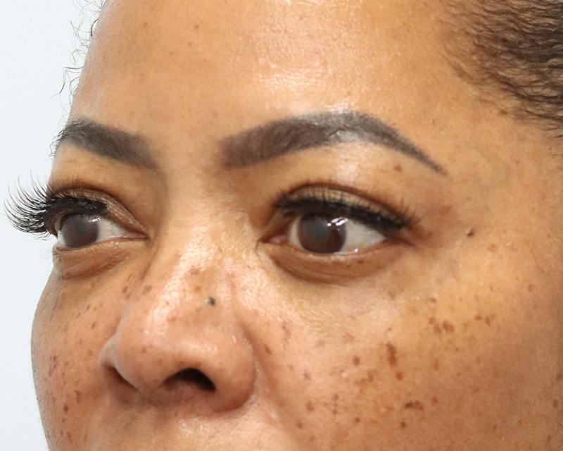 Blepharoplasty Before & After Gallery - Patient 409439 - Image 8