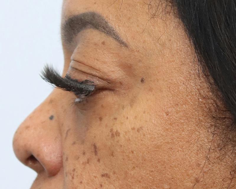 Blepharoplasty Before & After Gallery - Patient 409439 - Image 9