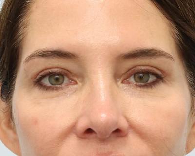 Blepharoplasty Before & After Gallery - Patient 614566 - Image 2