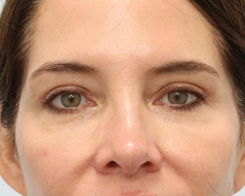 Blepharoplasty Before & After Gallery - Patient 614566 - Image 2