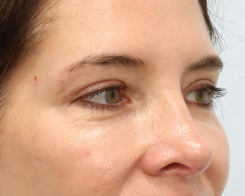 Blepharoplasty Before & After Gallery - Patient 614566 - Image 4