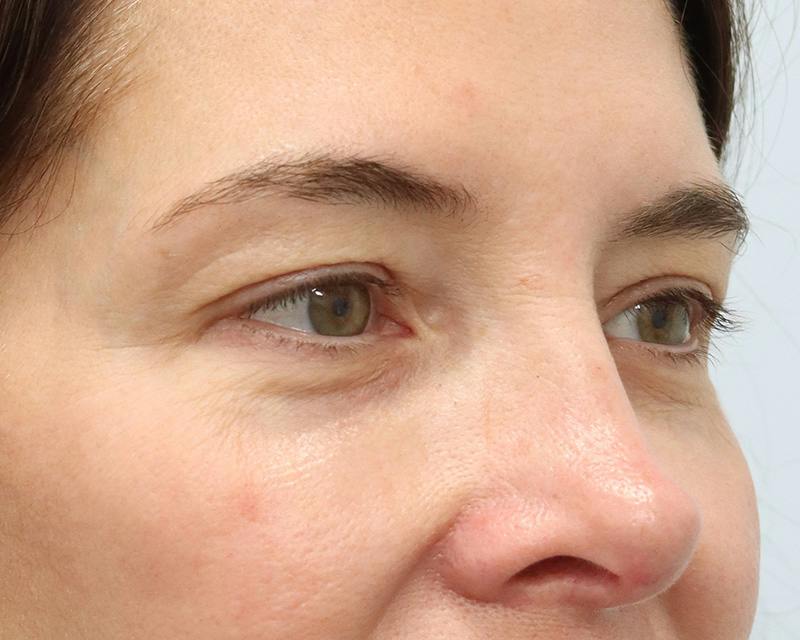 Blepharoplasty Before & After Gallery - Patient 614566 - Image 3