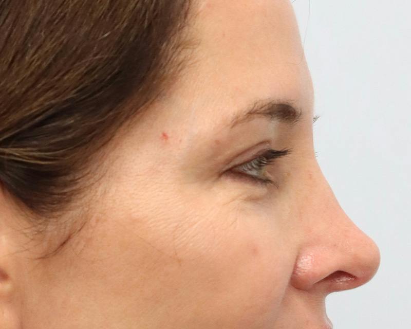 Blepharoplasty Before & After Gallery - Patient 614566 - Image 6