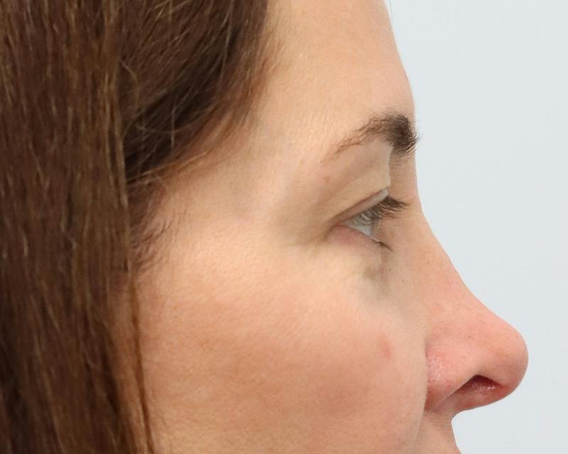 Blepharoplasty Before & After Gallery - Patient 614566 - Image 5