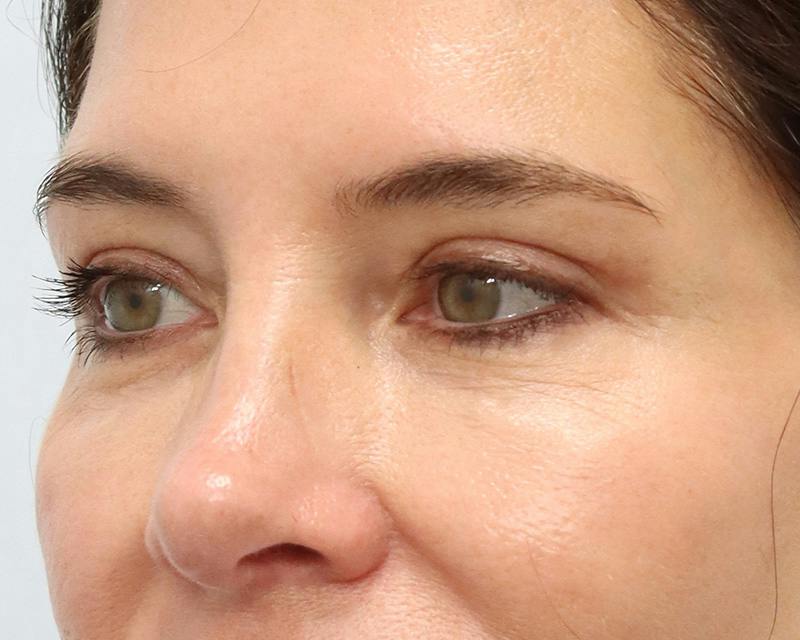 Blepharoplasty Before & After Gallery - Patient 614566 - Image 8
