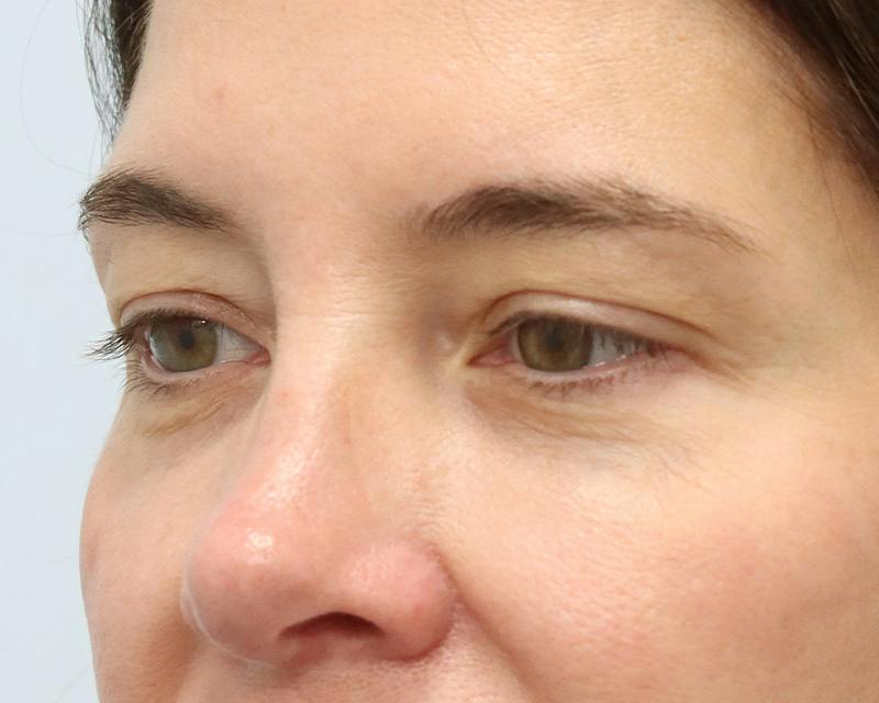 Blepharoplasty Before & After Gallery - Patient 614566 - Image 7