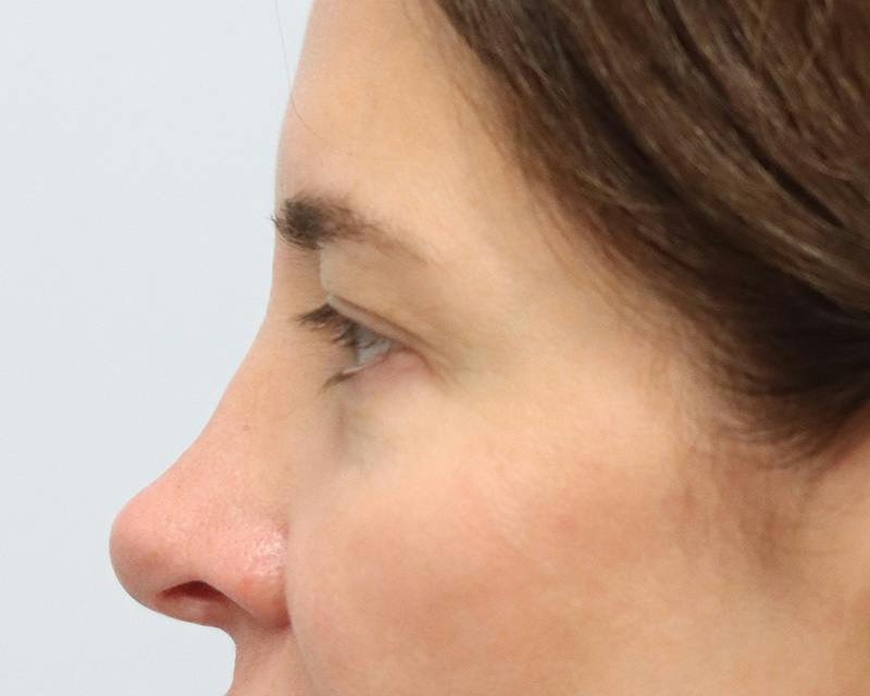 Blepharoplasty Before & After Gallery - Patient 614566 - Image 10