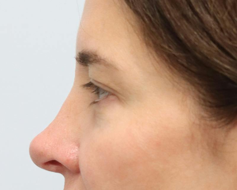 Blepharoplasty Before & After Gallery - Patient 614566 - Image 9