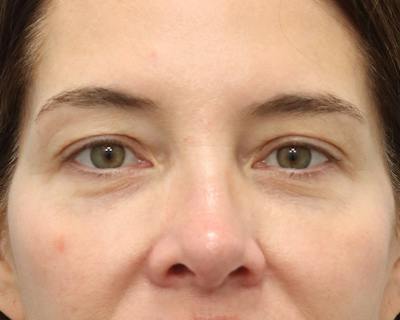 Blepharoplasty Before & After Gallery - Patient 614566 - Image 1