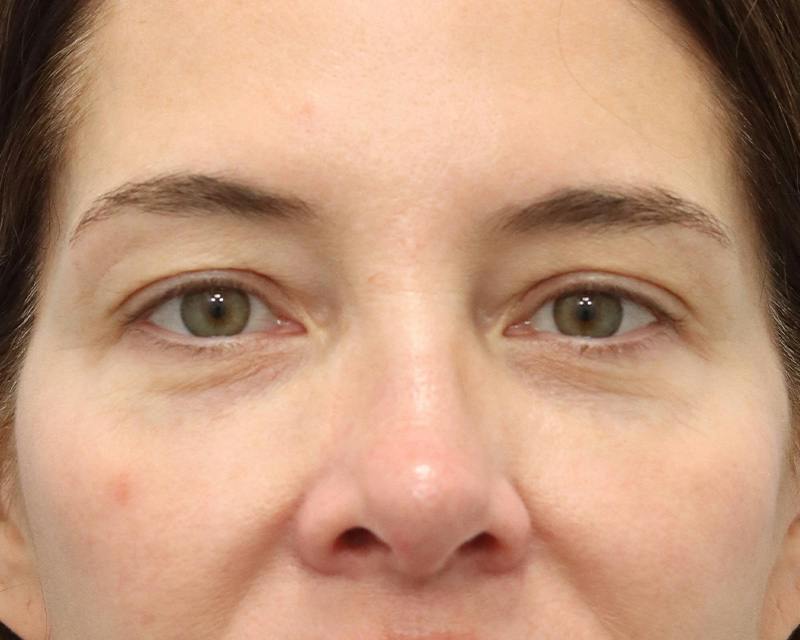 Blepharoplasty Before & After Gallery - Patient 614566 - Image 1