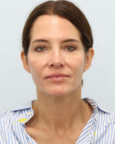 Lip Reduction  Before & After Gallery - Patient 228464 - Image 2