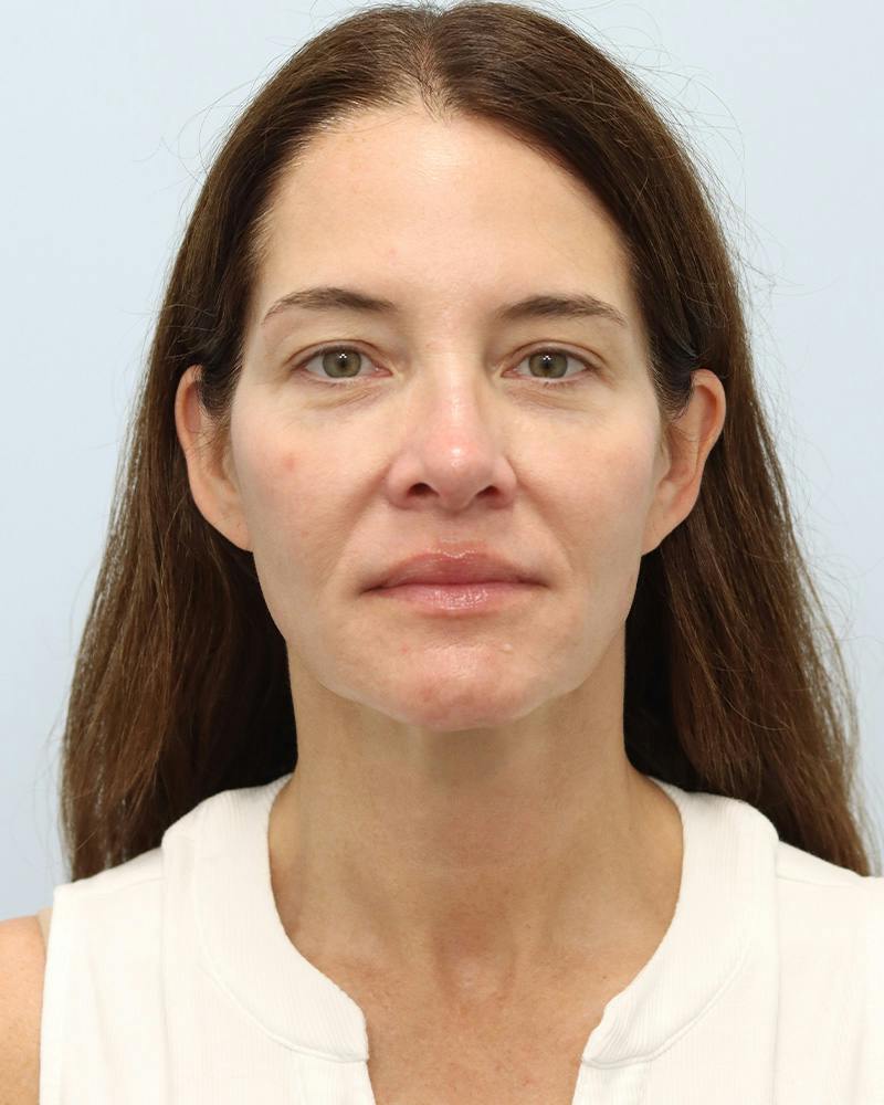 Microneedling Before & After Gallery - Patient 228414 - Image 1