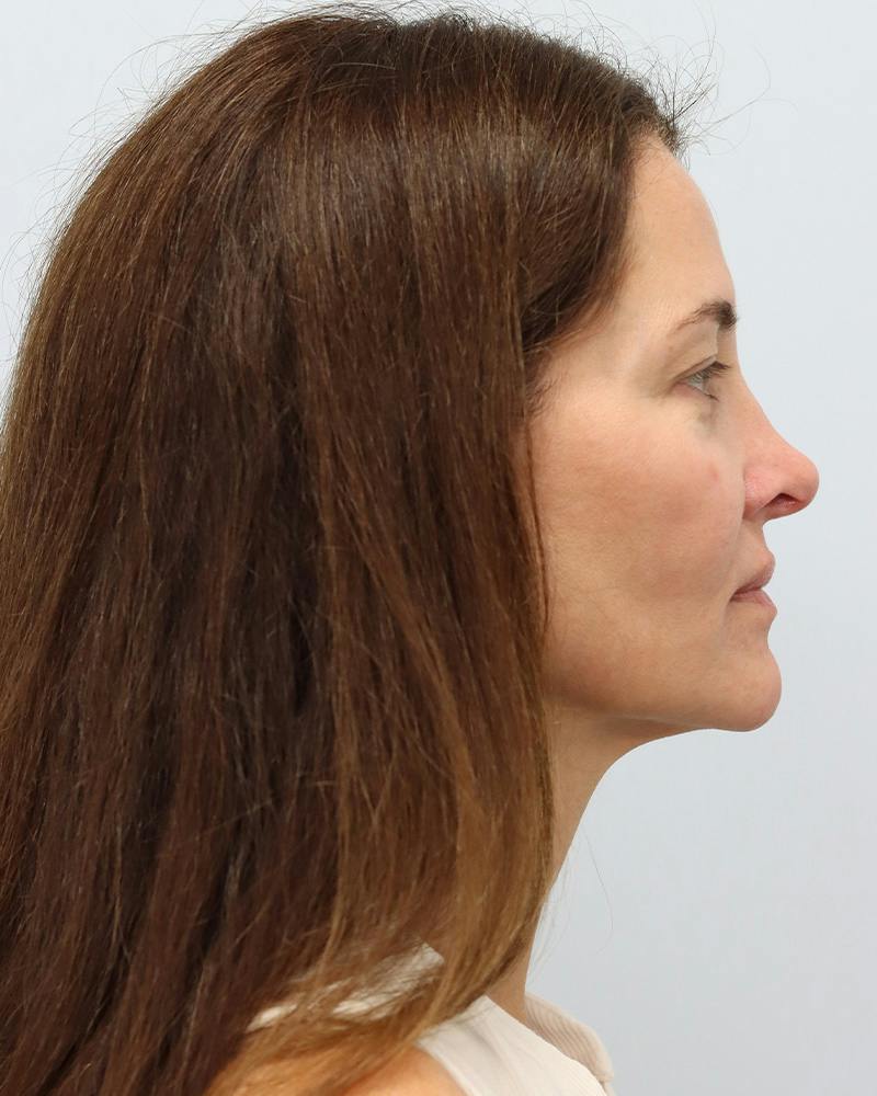 Microneedling Before & After Gallery - Patient 228414 - Image 5