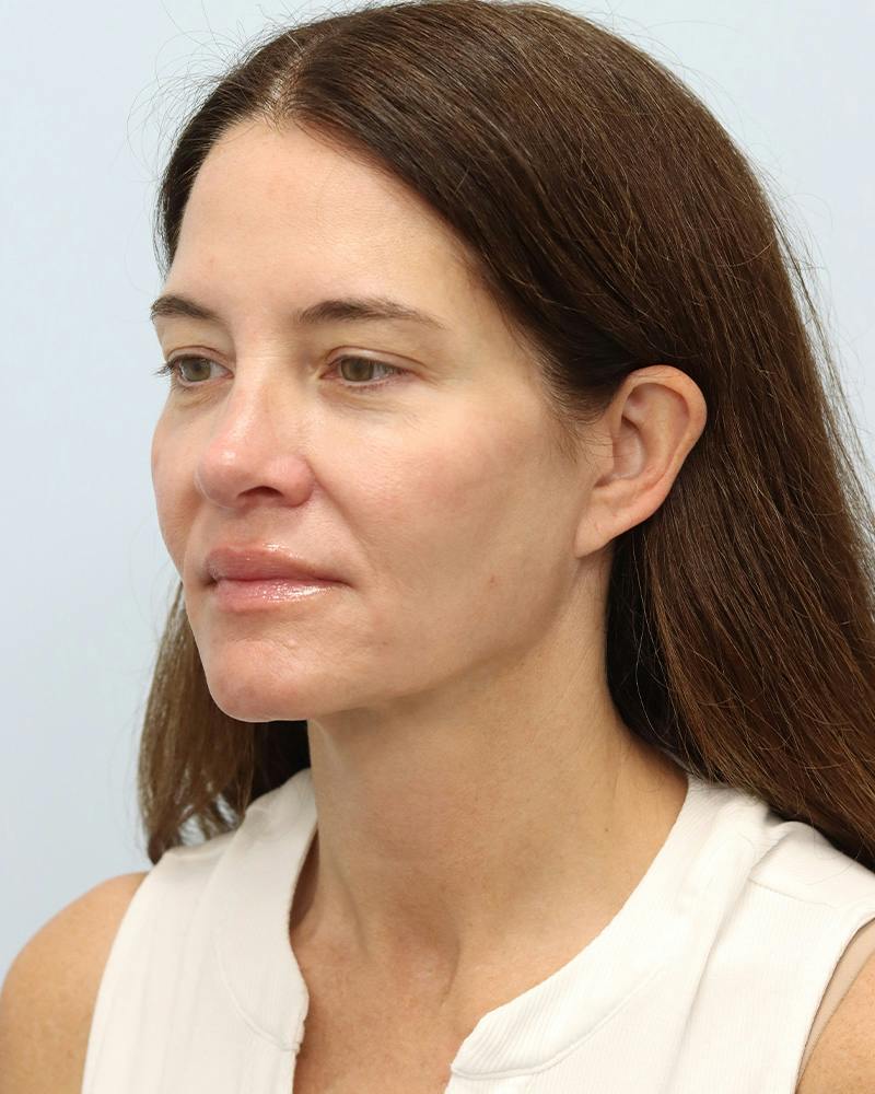 Microneedling Before & After Gallery - Patient 228414 - Image 7