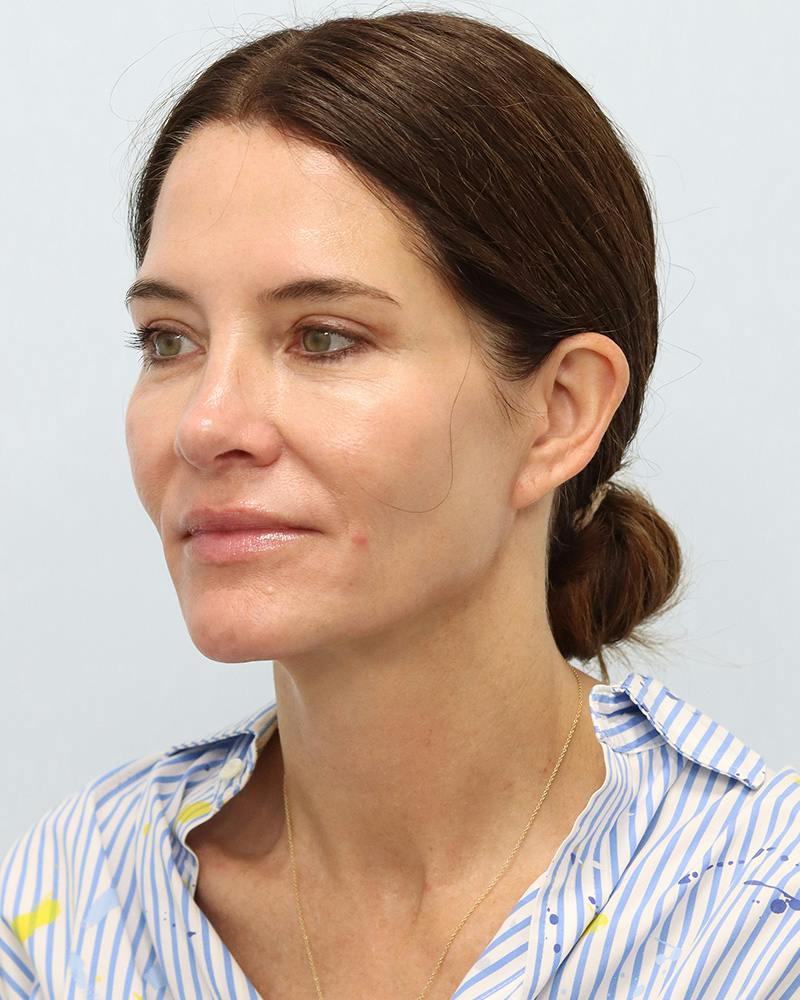 Microneedling Before & After Gallery - Patient 228414 - Image 8