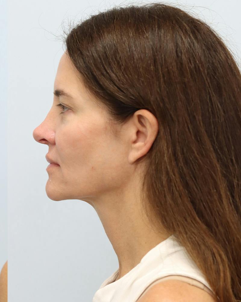 Microneedling Before & After Gallery - Patient 228414 - Image 9