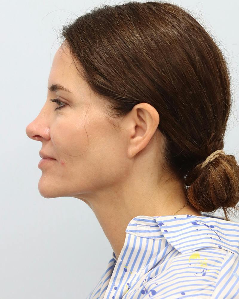 Microneedling Before & After Gallery - Patient 228414 - Image 10