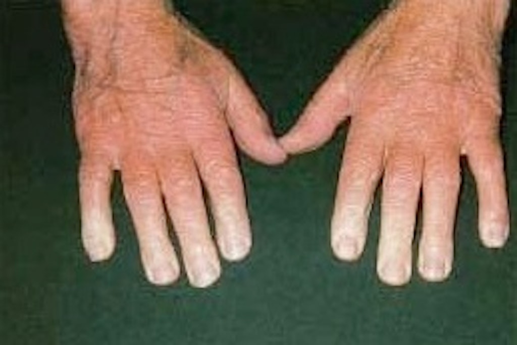 Example of white finger disease