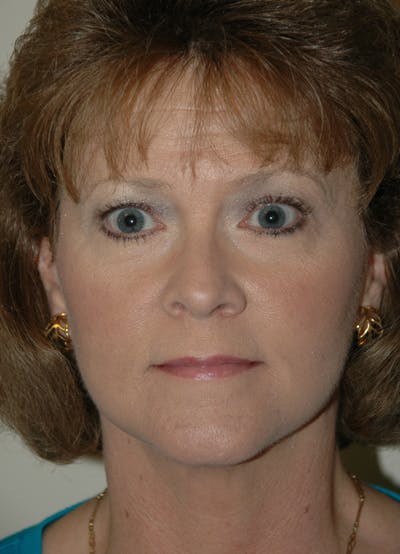 Facelift Before & After Gallery - Patient 53599892 - Image 2