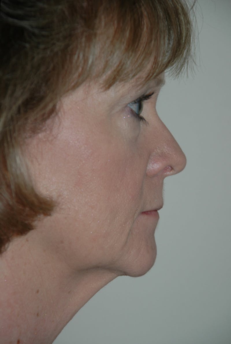 Facelift Before & After Gallery - Patient 53599892 - Image 3