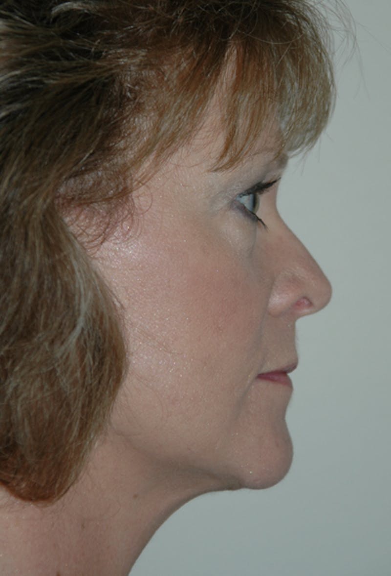 Facelift Before & After Gallery - Patient 53599892 - Image 4