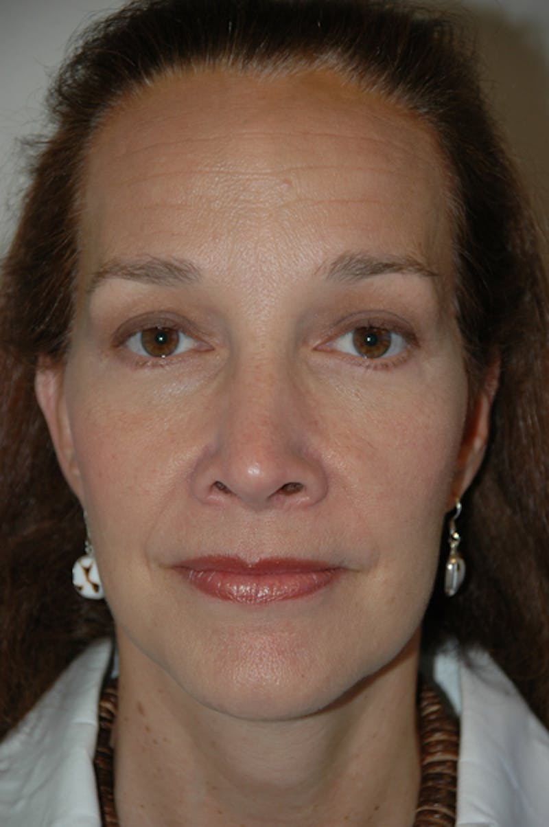Brow/Forehead Before & After Gallery - Patient 973608 - Image 2