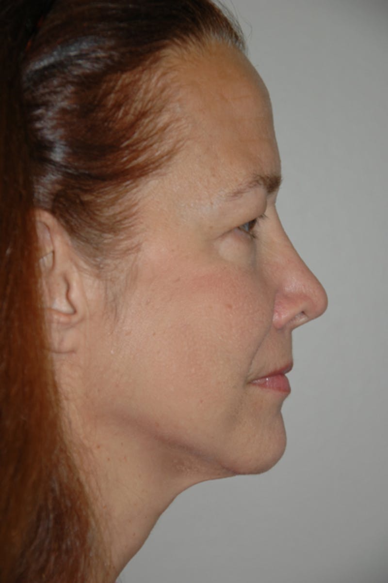 Brow/Forehead Before & After Gallery - Patient 973608 - Image 3