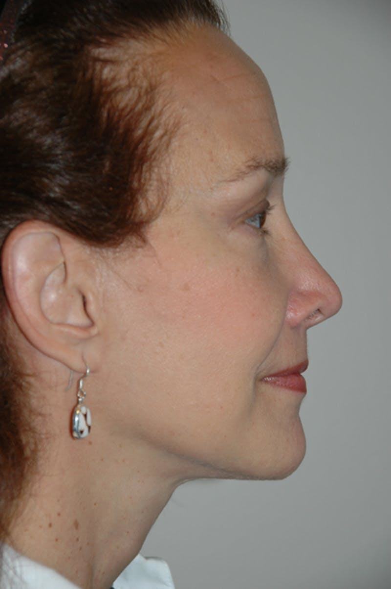 Brow/Forehead Before & After Gallery - Patient 973608 - Image 4